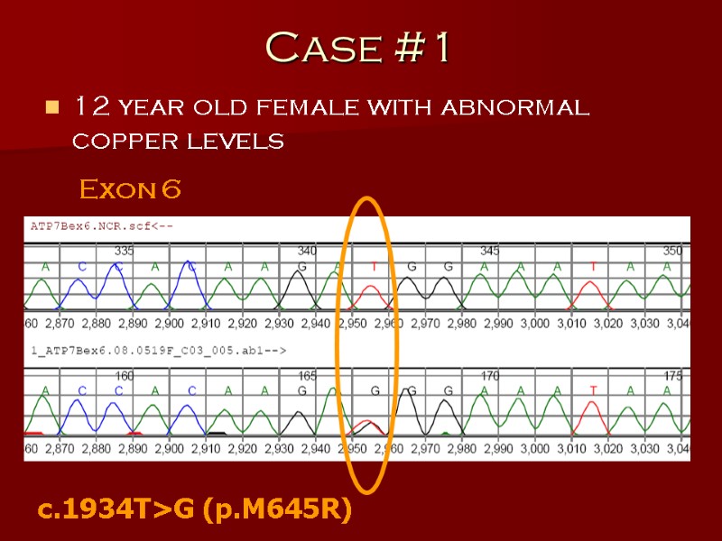 Case #1 12 year old female with abnormal copper levels Exon 6 c.1934T>G (p.M645R)